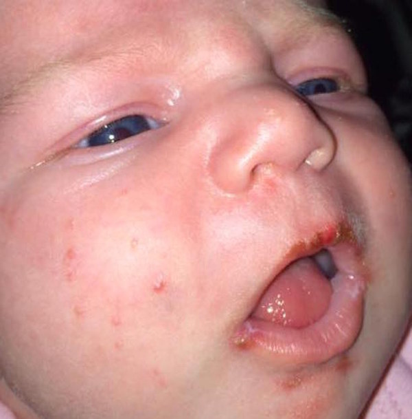bebeherpes2
