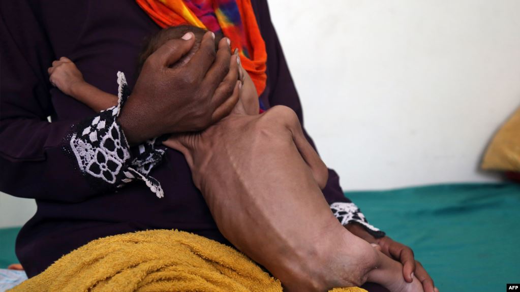 Az qidalanan minlərlə uşaq COVID-19 böhranında ölə bilər