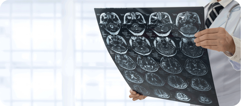 Enfermedades Cerebrovasculares