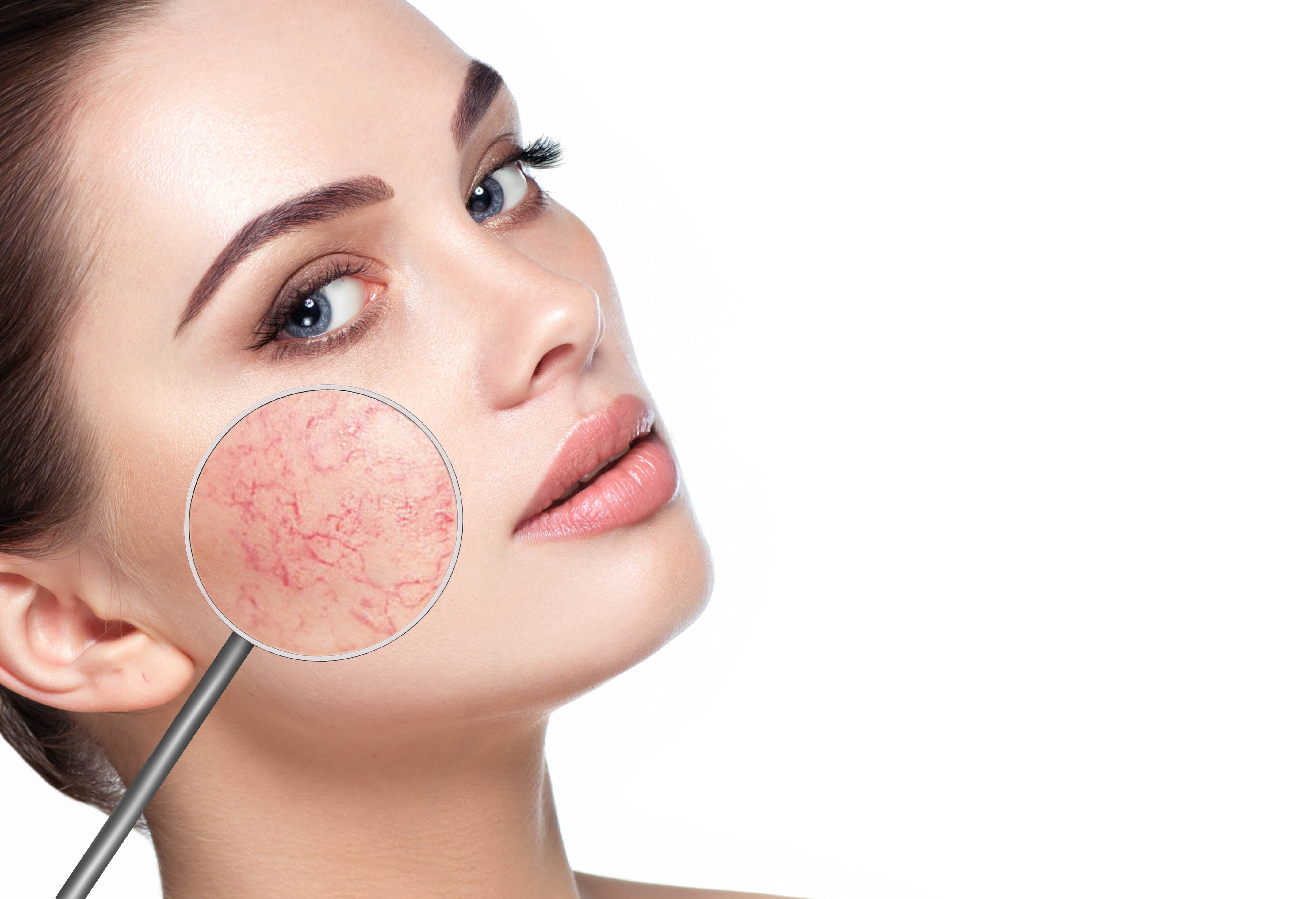Couperose lässt sich mit dem TriBella® Concept sehr gut behandeln.