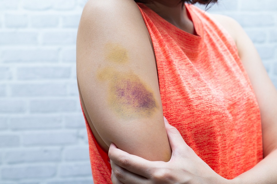 Eine Frau in einem orangen ärmellosen Shirt hält sich den Arm. Am Oberarm ist ein riesiger, abheilender Bluterguss zu sehen.