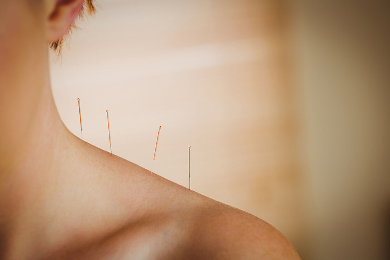 Junge Frau mit Akupunktur-Nadeln auf den Schultern | Credit: iStock.com/Wavebreakmedia