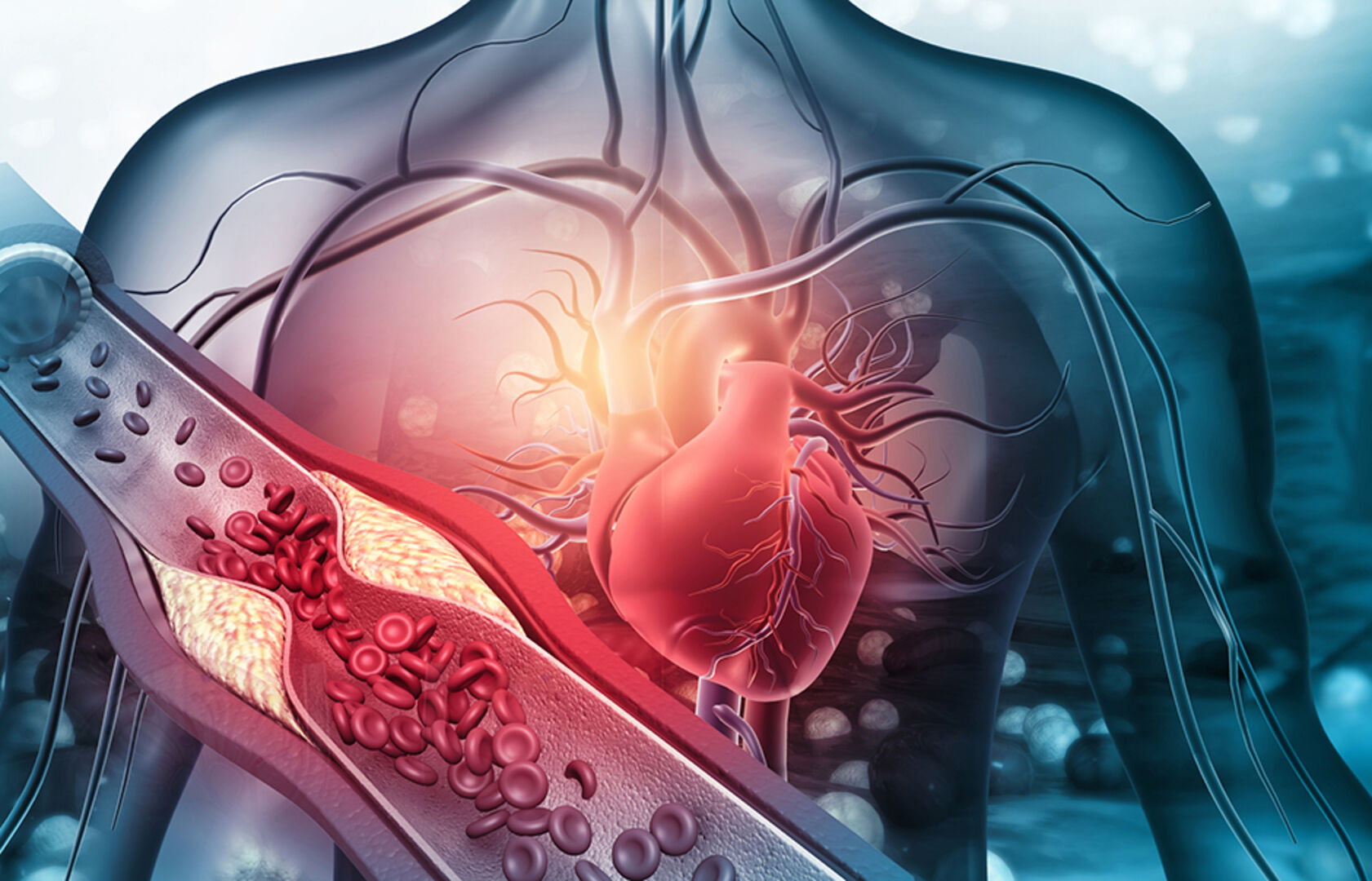Menschliches Herz mit verstopften Arterien | Credit: iStock.com/Rasi Bhadramani