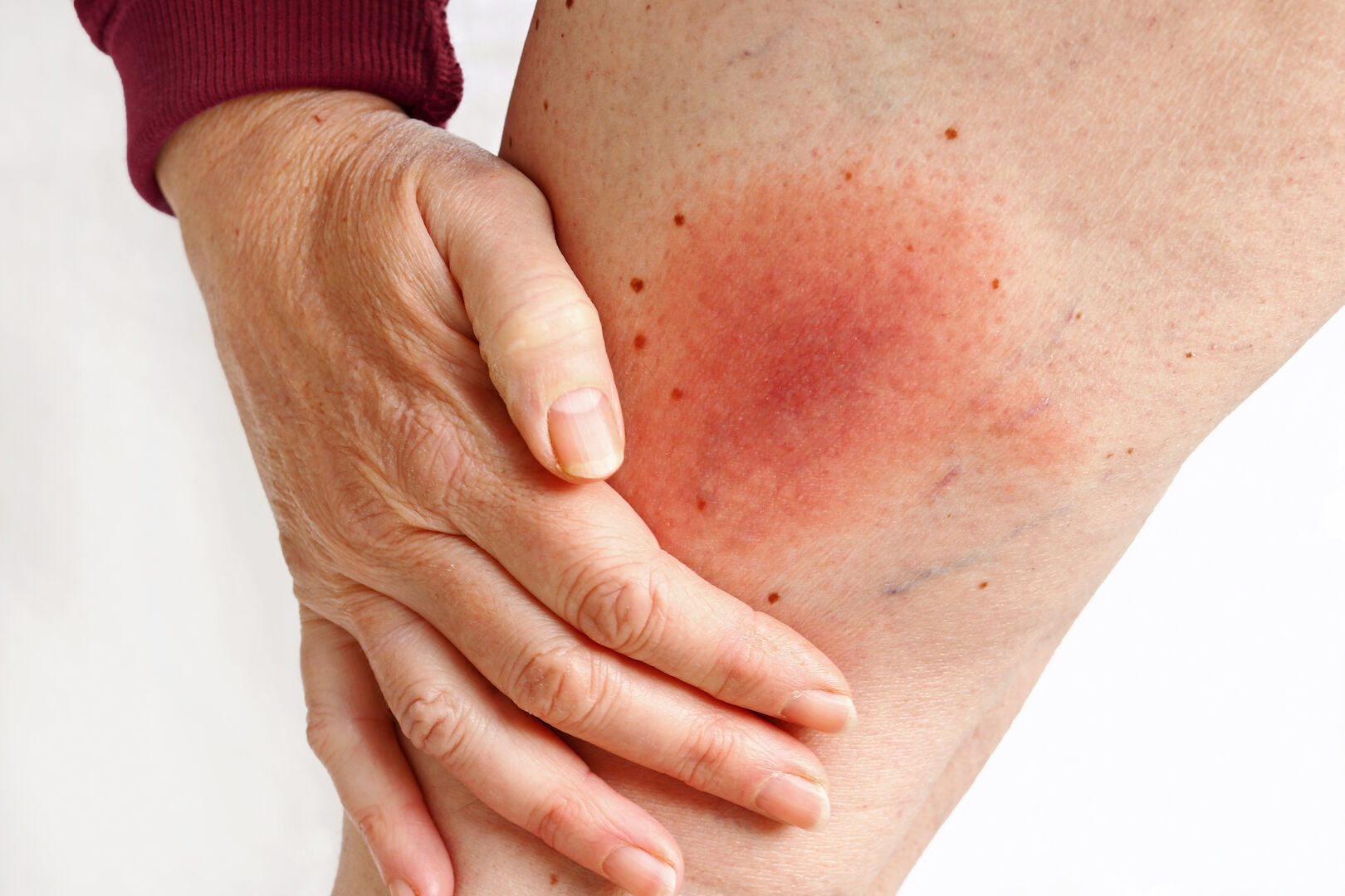 Hautrötungen sind ein Symptom von Borreliose. | Credit: iStock.com/Astrid860
