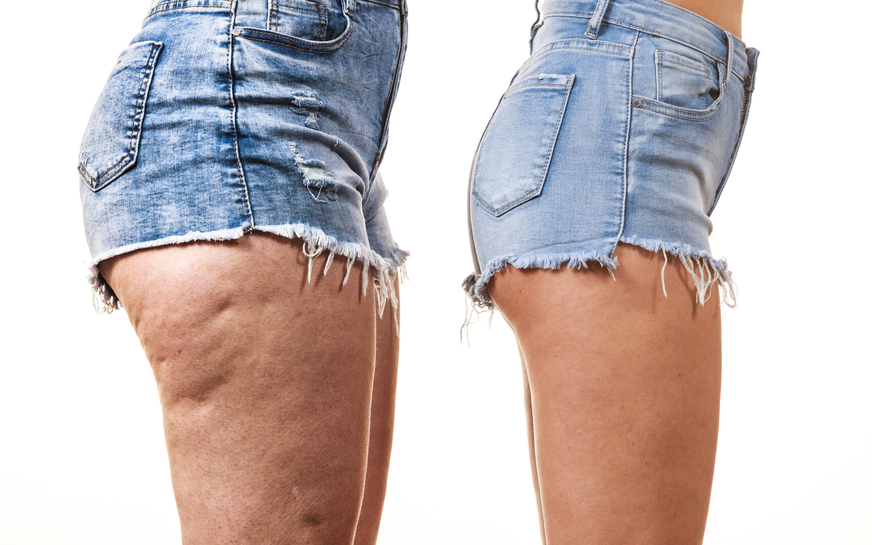 Mit diesen Tipps lässt sich das Hautbild verbessern. | Credit: iStock.com/Anetlanda