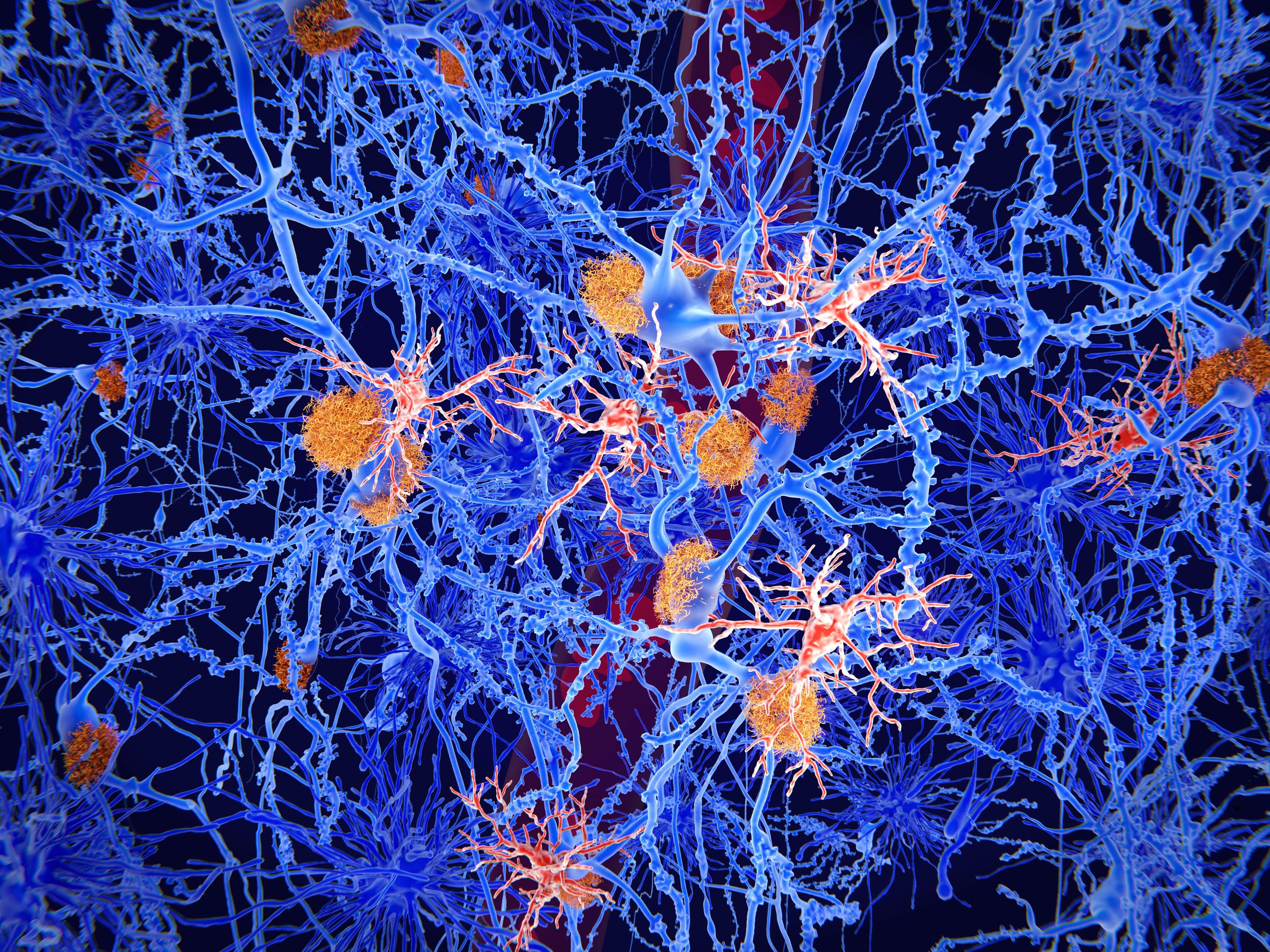 Alzheimer verursacht Schäden im Hirn. | Credit: iStock.com/ selvanegra
