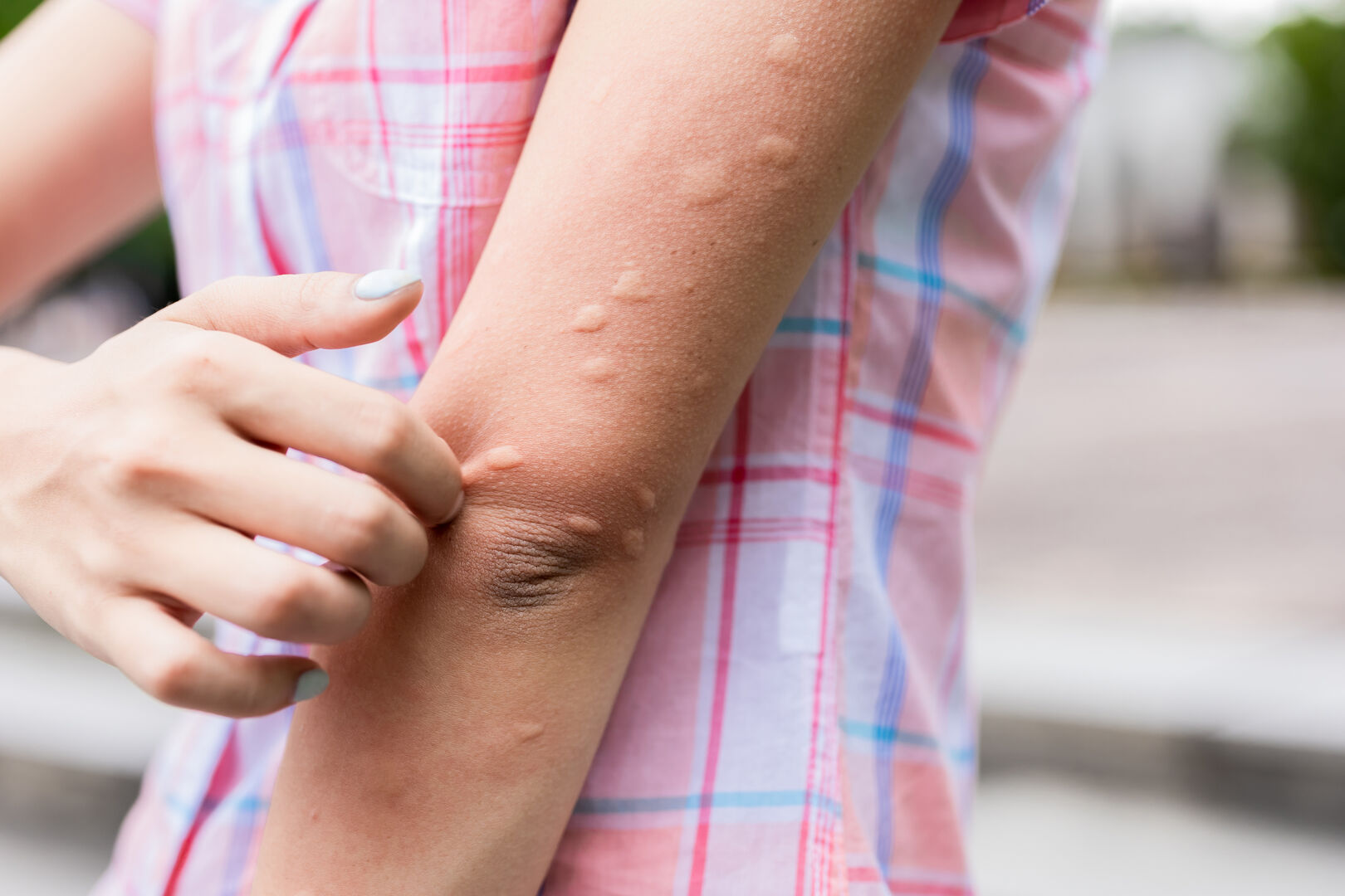 Kälteallergie | Credit: iStock.com/ RyanKing999