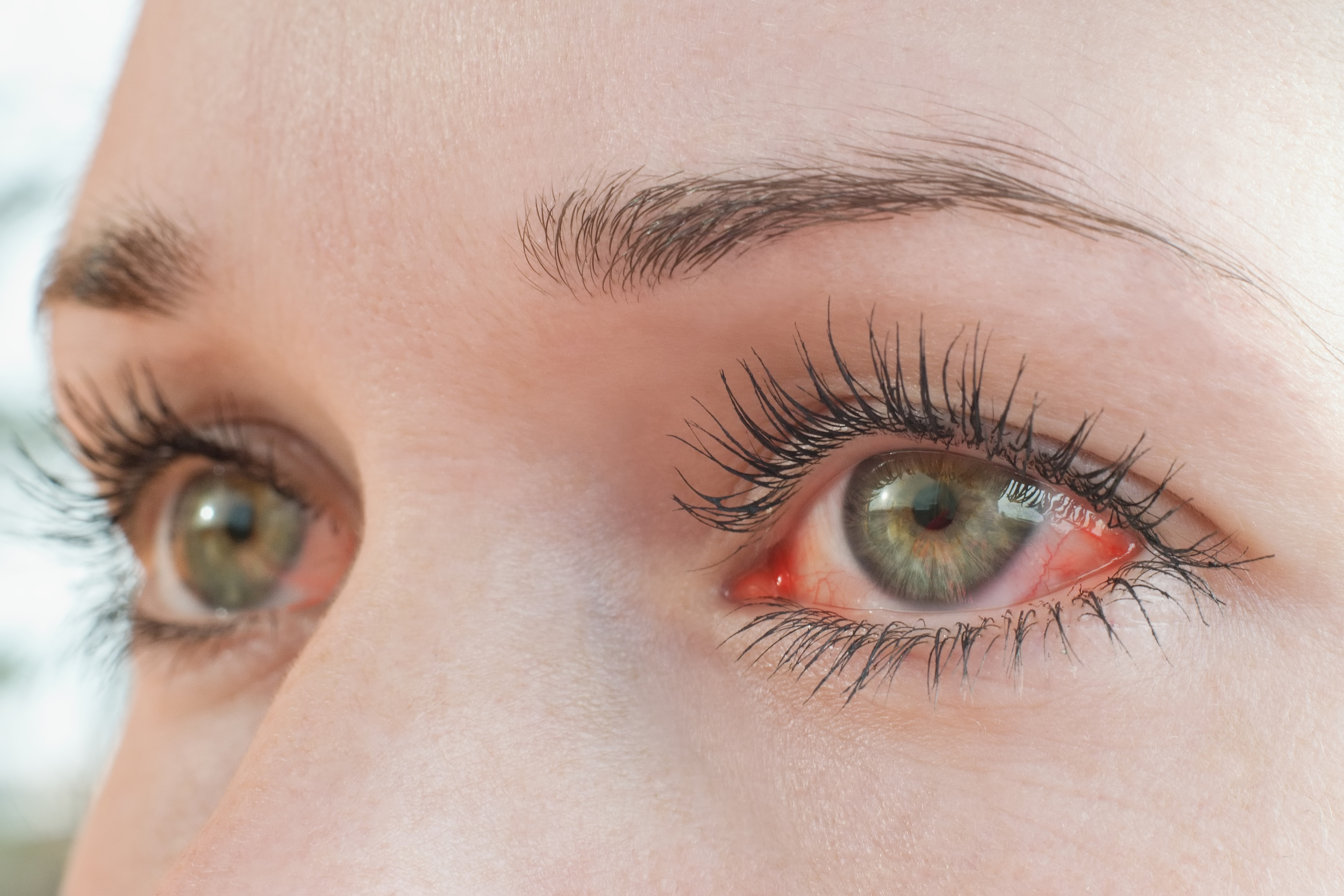Gerötete Augen | Credit: iStock.com/Tunatura