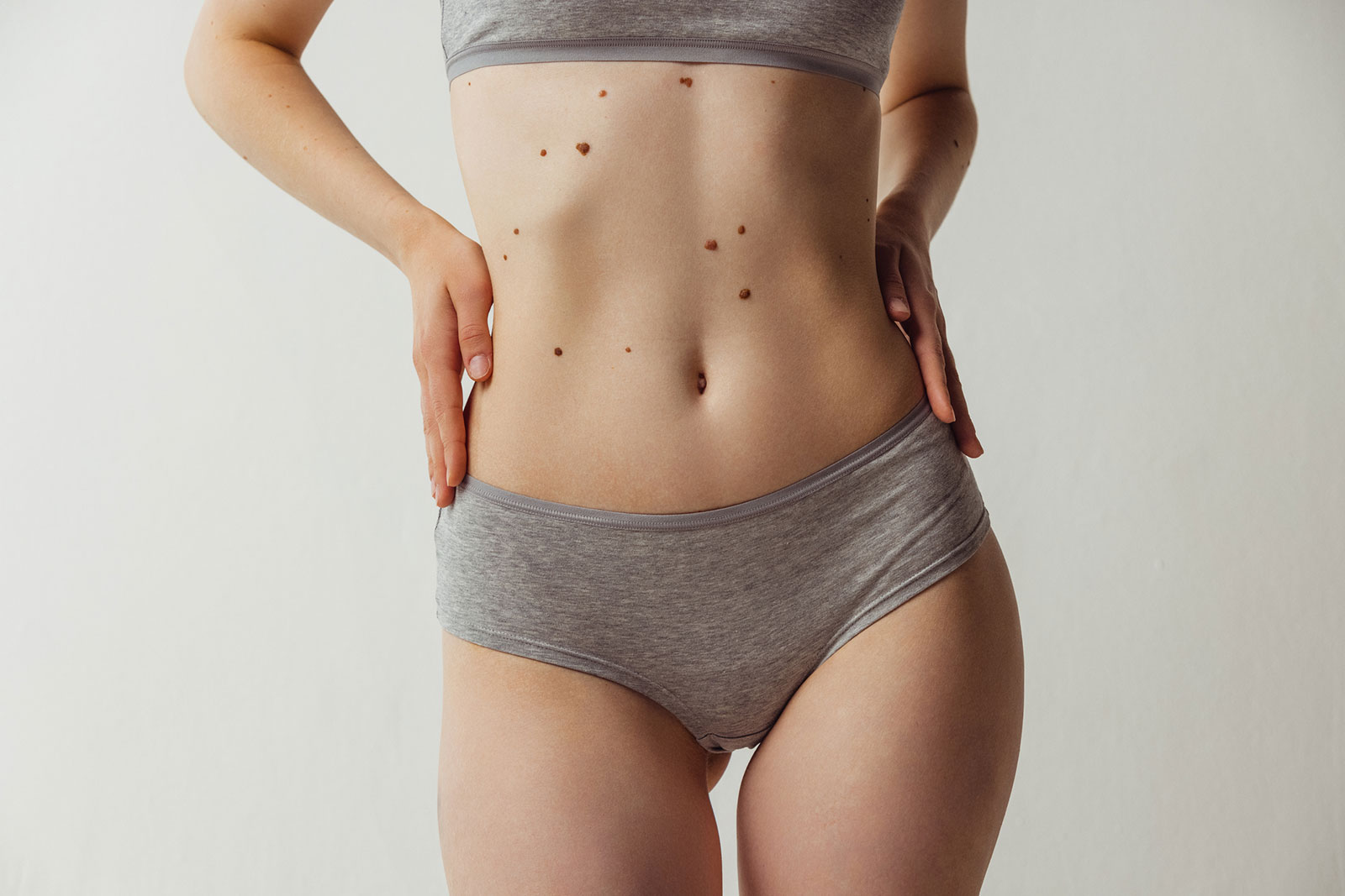 Junge Frau mit vielen Muttermalen auf dem Körper | Credit: iStock.com/master1305