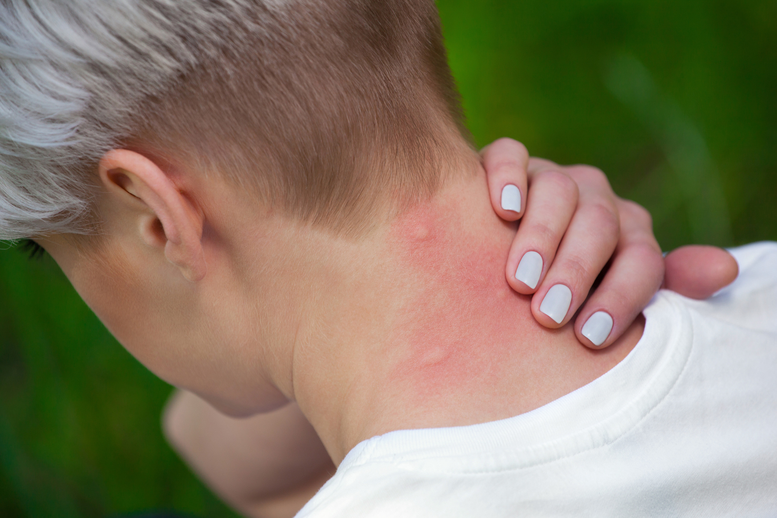 Gelsenstiche auf Hals einer Frau. | Credit: iStock.com/dimid_86
