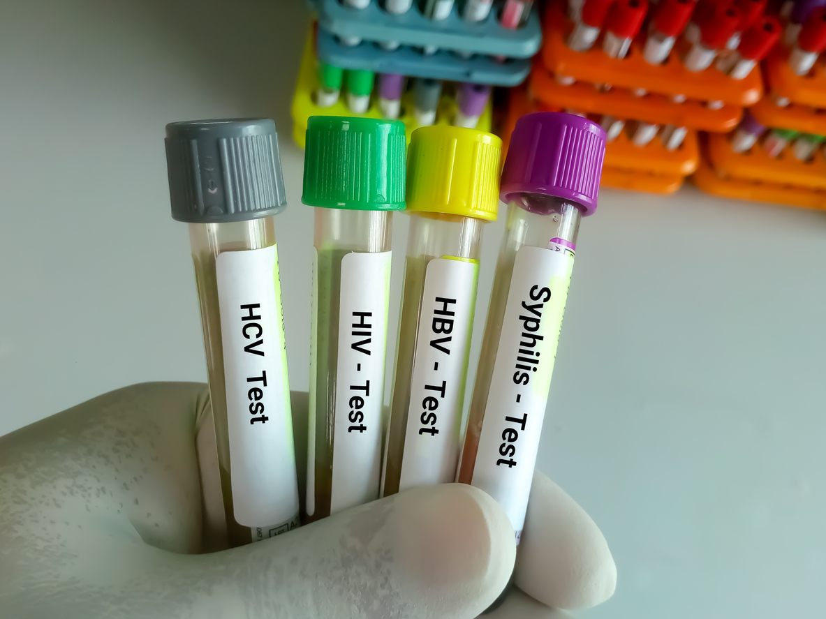 Verschiedene Tests für sexuell übertragbare Infektionen