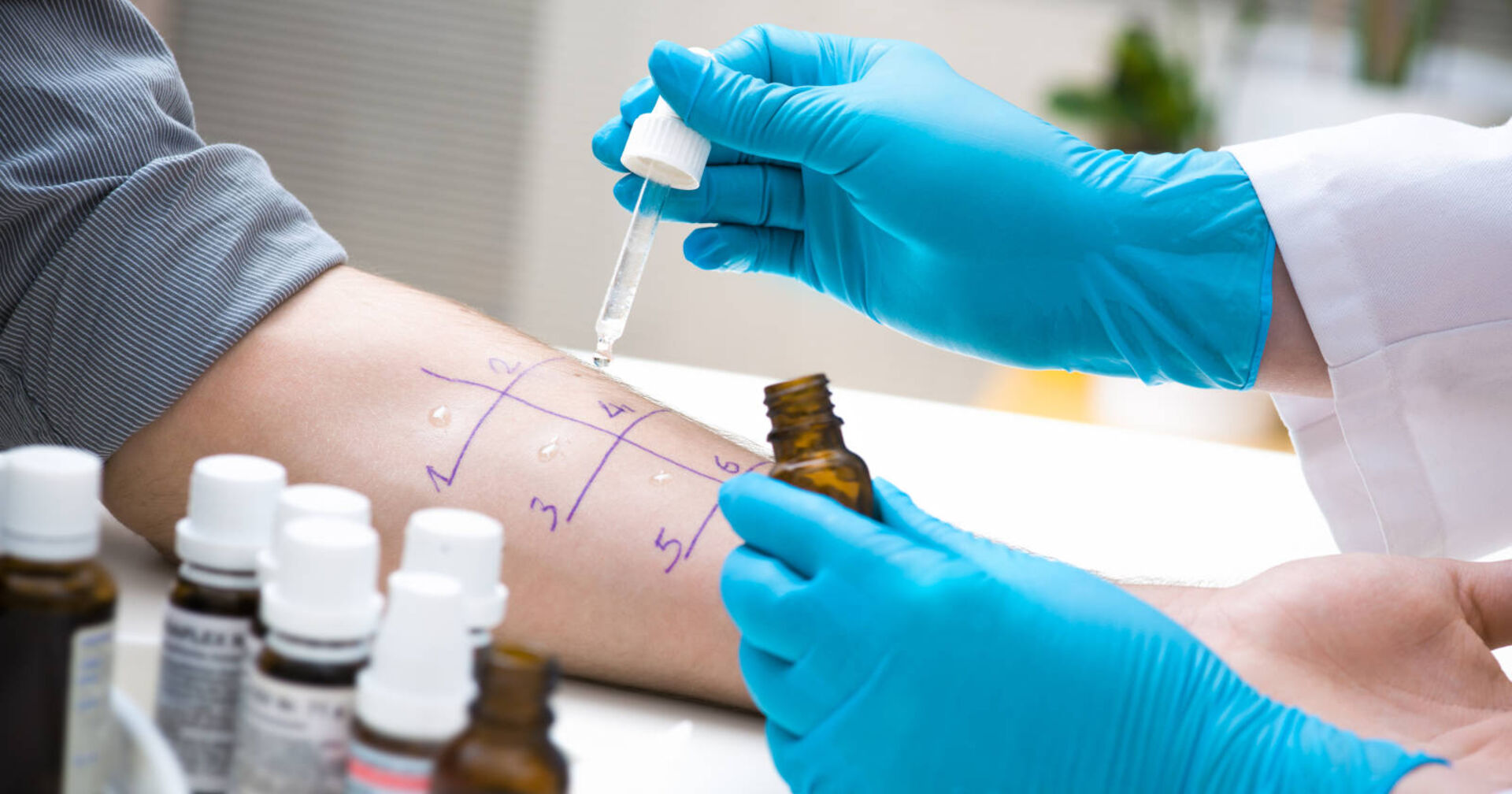 Pollenallergie: Ein Arzt macht einen Allergietest auf dem Unterarm eines Patienten.