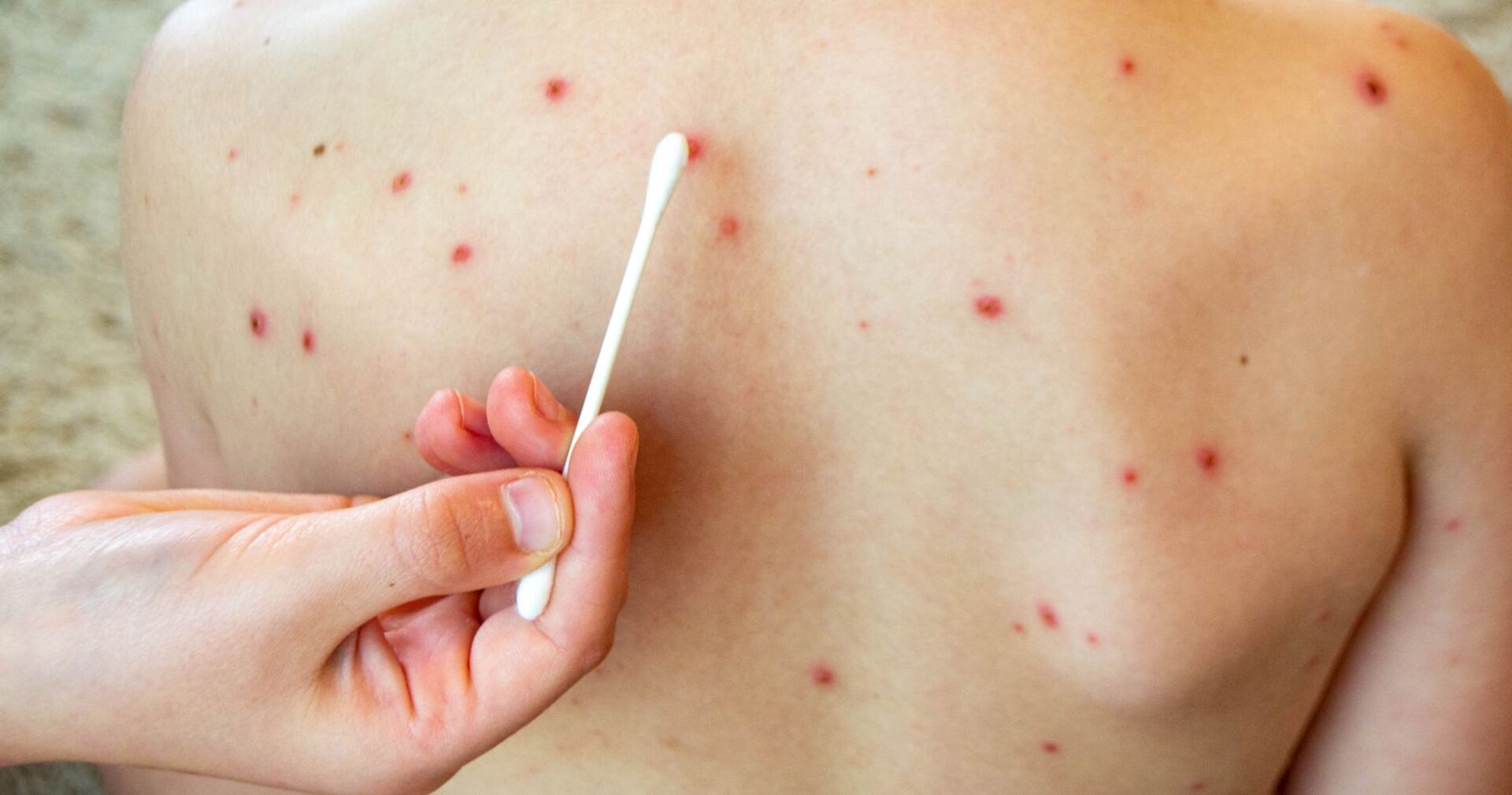 Ein Rücken mit Masern-Punkten.