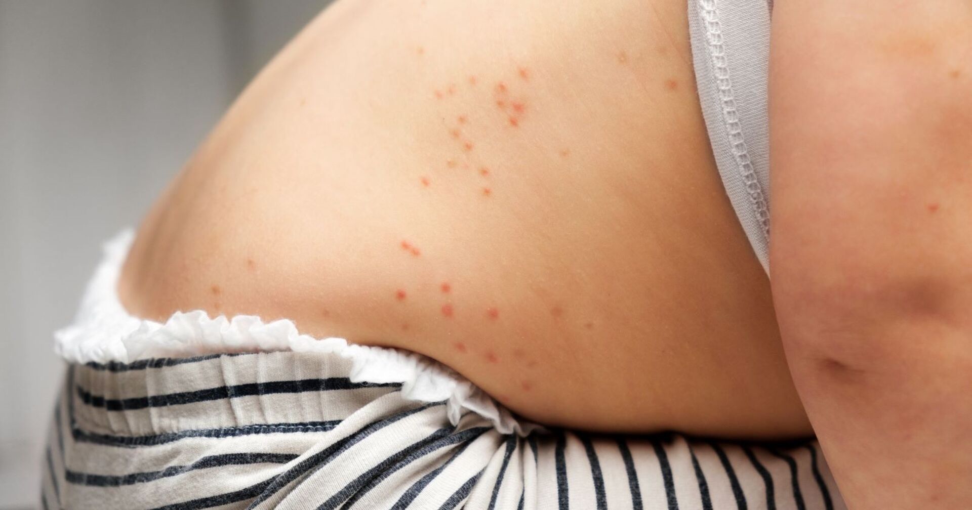 Ein Kind mit Masern-Ausschlag.