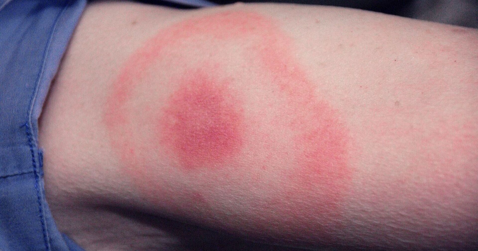 Rötlicher, ringförmiger Hautausschlag auf heller Haut – typisches Anzeichen für Lyme-Borreliose nach einem Zeckenbiss.