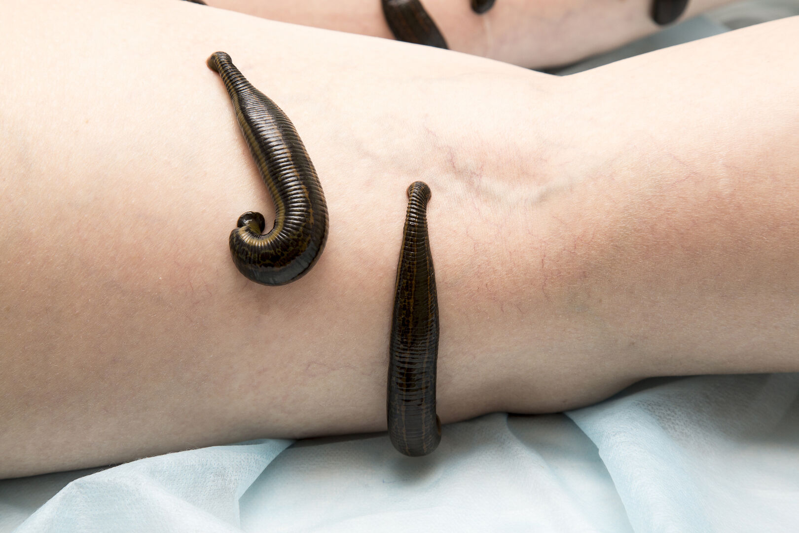 Nahaufnahme eines Beines, an dem sich mehrere Blutegel festgesaugt haben