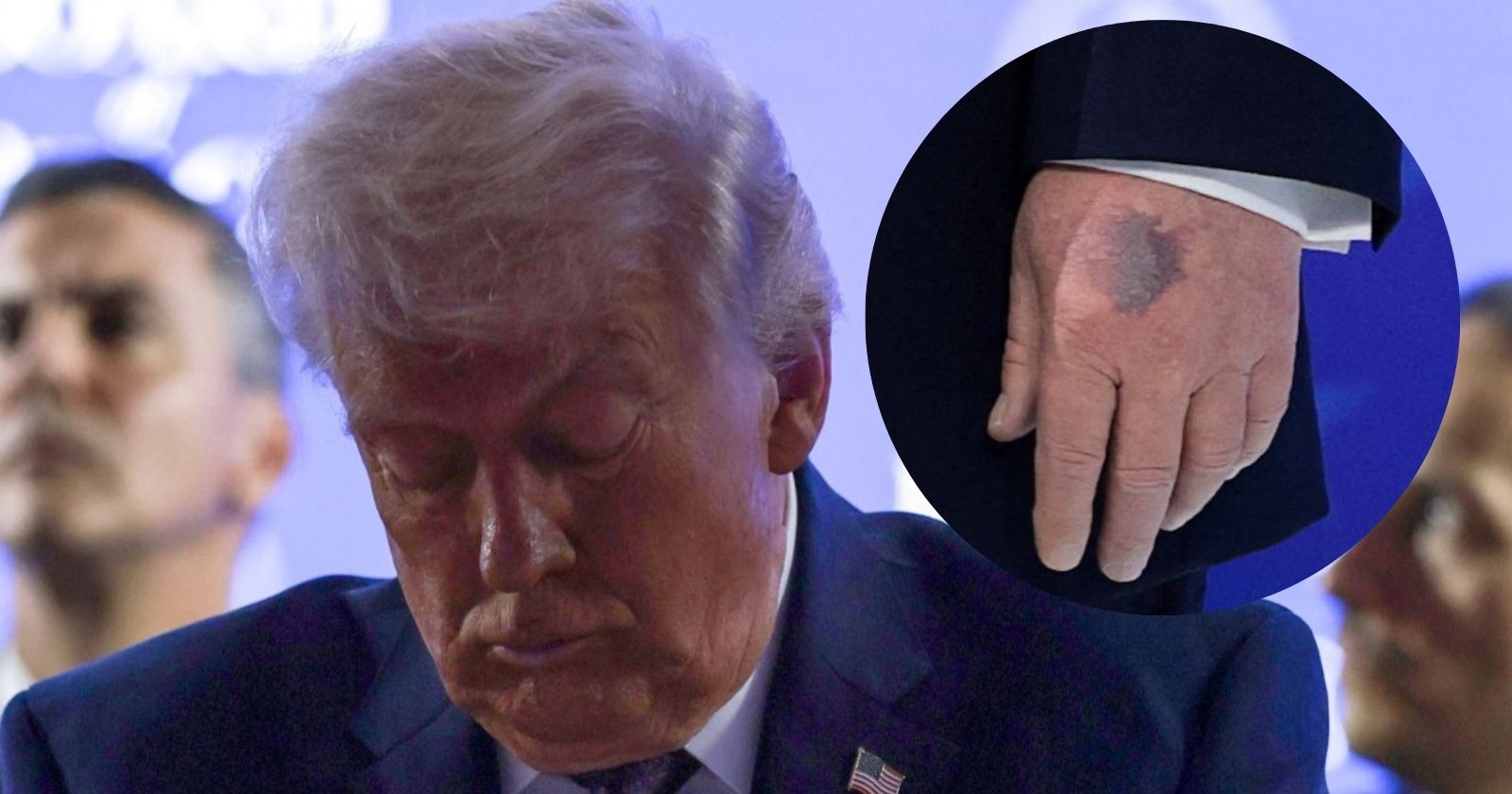 Donald Trump mit gesenktem Blick beim Weltwirtschaftsforum in Davos; eingeblendetes Detail zeigt seine linke Hand mit einem deutlich sichtbaren blauen Fleck.