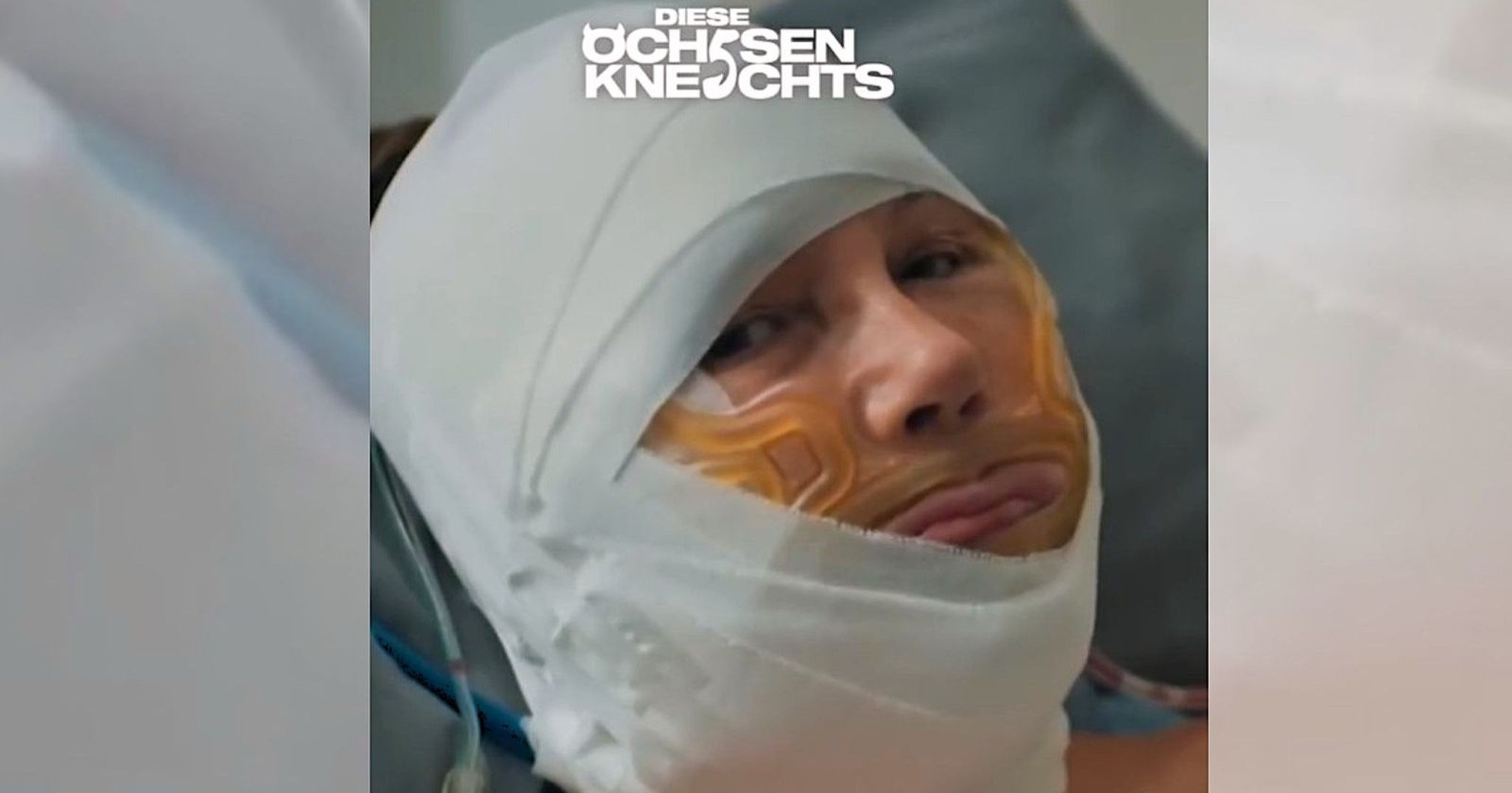 Natascha Ochsenknecht nach ihrer Halsstraffung in der Reality-Serie „Diese Ochsenknechts“ mit bandagiertem Kopf und geschwollenem Gesicht kurz nach der Beauty-OP.