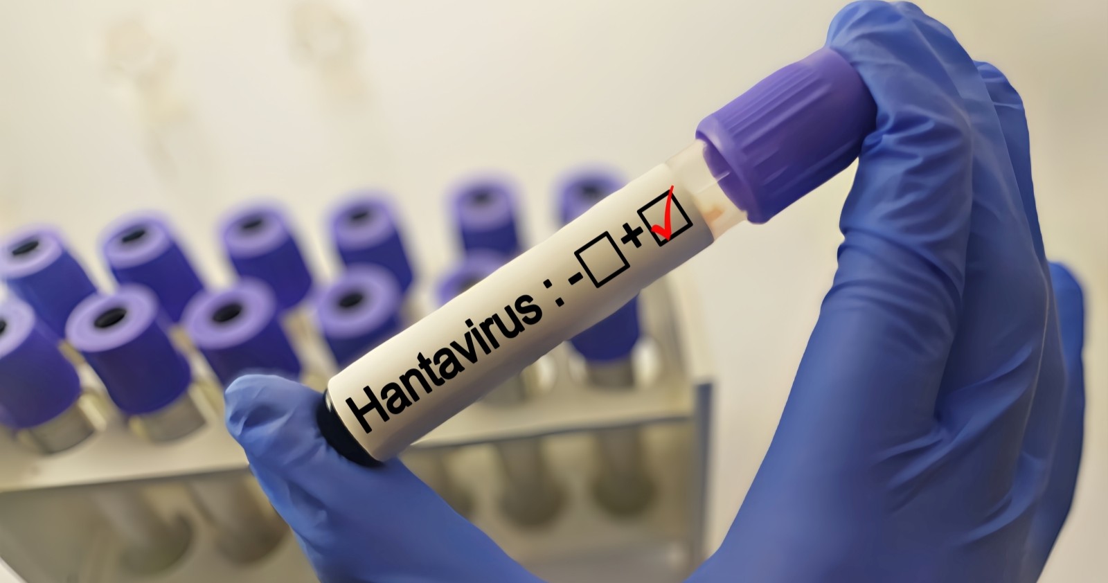 Blutprobe für Hantavirus-Test im medizinischen Labor.