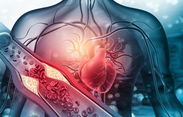 Menschliches Herz mit verstopften Arterien | Credit: iStock.com/Rasi Bhadramani