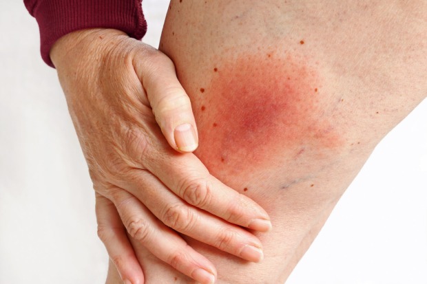 Hautrötungen sind ein Symptom von Borreliose. | Credit: iStock.com/Astrid860