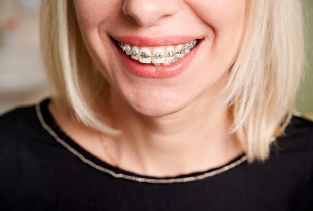 Blonde Frau lächelt mit Zahnspange | Credit: iStock.com/anatoliy_gleb