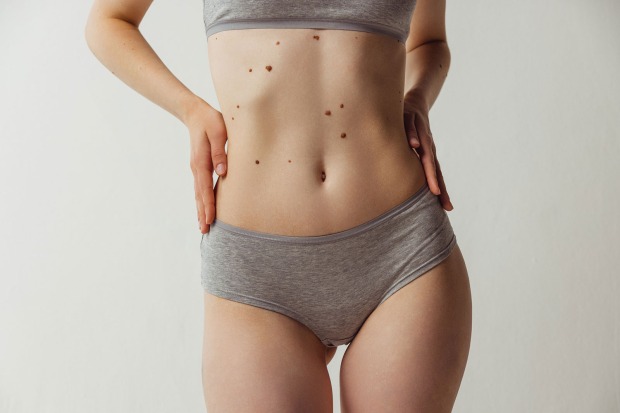 Junge Frau mit vielen Muttermalen auf dem Körper | Credit: iStock.com/master1305