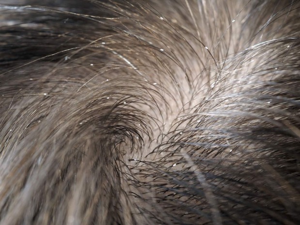 Eier von Kopflaus in den Haaren.
