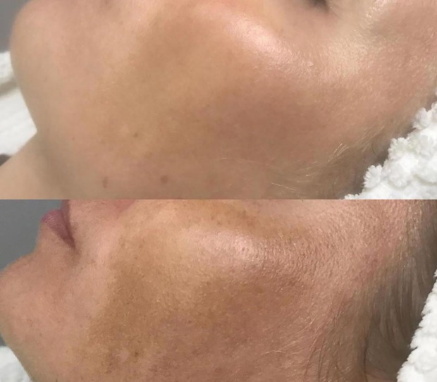 Wangen einer Frau vor und nach einer Hydrafacial Behandlung | Credit: Individual Beauty
