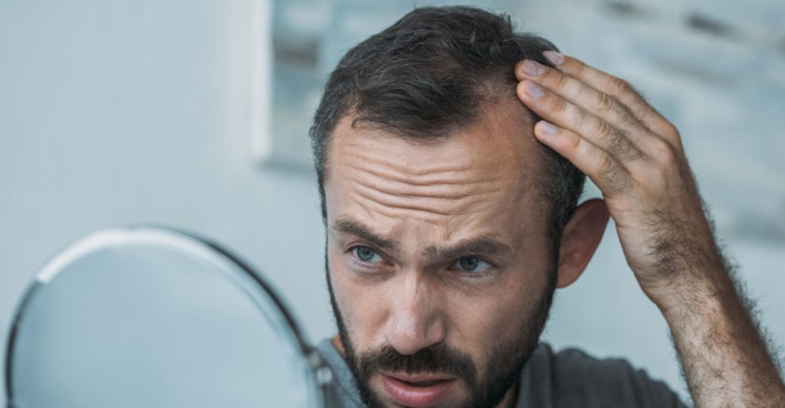 Nicht jede/r ist mit voller Haarpracht gesegnet | Credit: LightFieldStudios/iStock.com