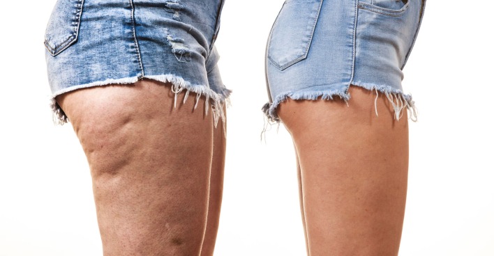 Mit diesen Tipps lässt sich das Hautbild verbessern. | Credit: iStock.com/Anetlanda