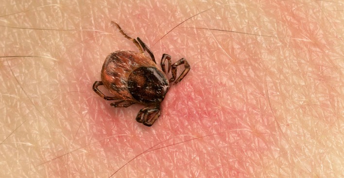 Zeckenstich mit geröteter Haut