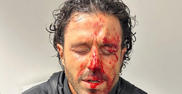 Nahaufnahme des blutverschmierten Gesichts von Fabio Grosso