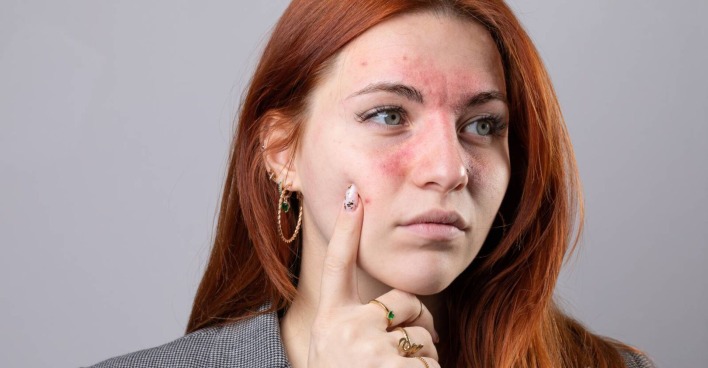 Nahaufnahme einer jungen Frau mit geröteten Wangen, die an Rosacea leidet