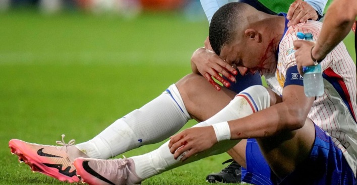 Mbappe sitzt am Rasen, den Kopf zwischen den Beinen und die Nase haltend. Er blutet. Helfer reichen ihm Wasser.