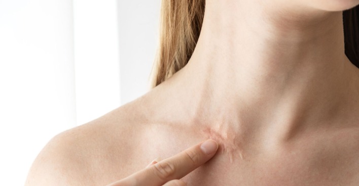 Frau hat Narbe am Hals | Credit: iStock.com/Anna Gorbacheva