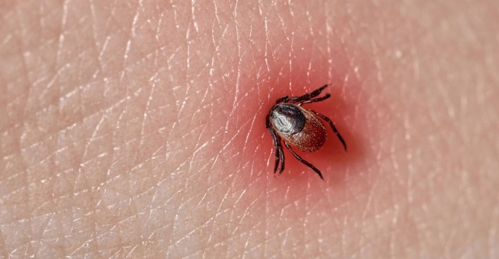 Nahaufnahme einer Zecke, die sich in geröteter menschlicher Haut festgesetzt hat – mögliche Übertragungsquelle für Lyme-Borreliose.