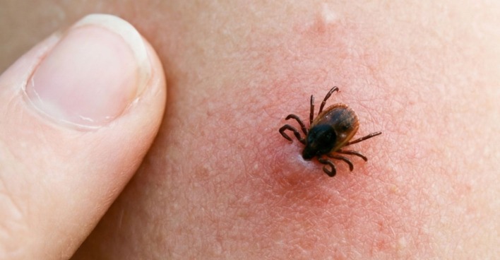 Zeckenbiss auf der Haut, die Tiere übertragen bereits seit 20 Jahren ALSV