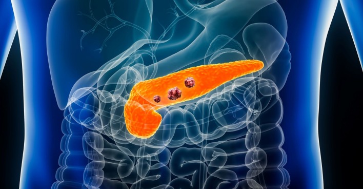 Darstellung der Bauchspeicheldrüse mit Tumoren im menschlichen Körper als Illustration für Bauchspeicheldrüsenkrebs und Risikofaktoren wie Alkohol