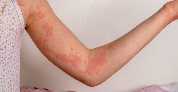 Allergische Reaktion: Pusteln auf der Haut am Arm. | Credit: iStock.com/Eik Scott