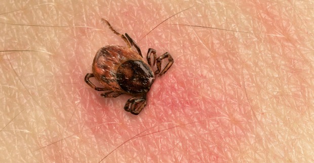 Zeckenstich mit geröteter Haut