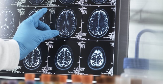 MRI-Bilder eines Gehirn.