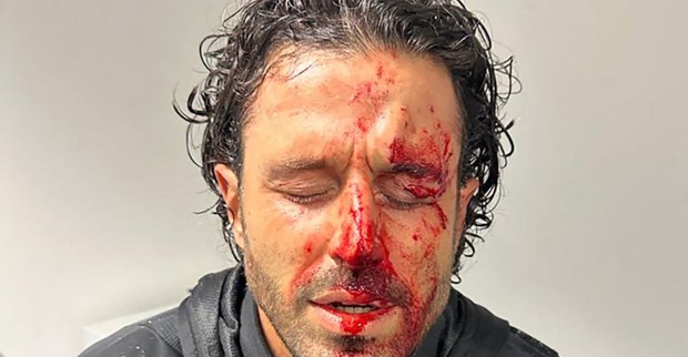 Nahaufnahme des blutverschmierten Gesichts von Fabio Grosso