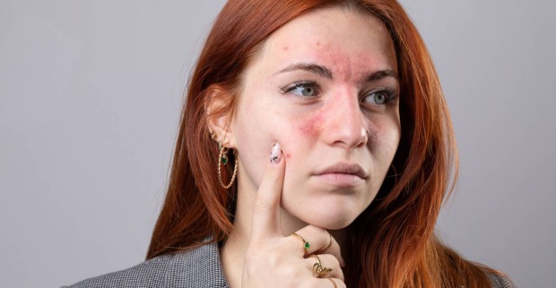 Nahaufnahme einer jungen Frau mit geröteten Wangen, die an Rosacea leidet