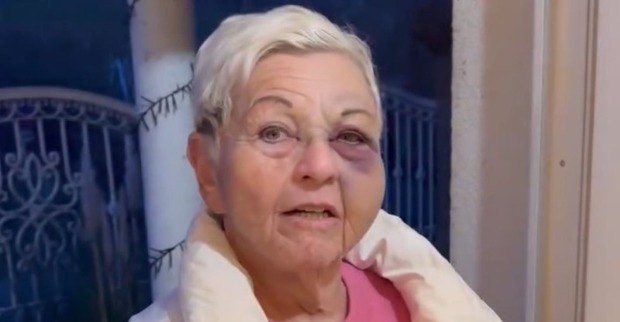 Jazz Gitti mit blauem Auge