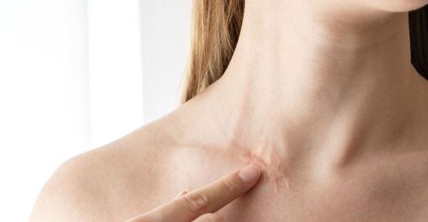 Frau hat Narbe am Hals | Credit: iStock.com/Anna Gorbacheva