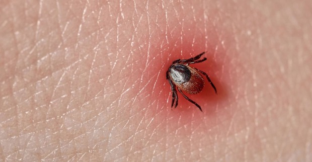 Nahaufnahme einer Zecke, die sich in geröteter menschlicher Haut festgesetzt hat – mögliche Übertragungsquelle für Lyme-Borreliose.