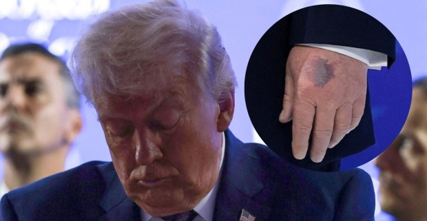 Donald Trump mit gesenktem Blick beim Weltwirtschaftsforum in Davos; eingeblendetes Detail zeigt seine linke Hand mit einem deutlich sichtbaren blauen Fleck.