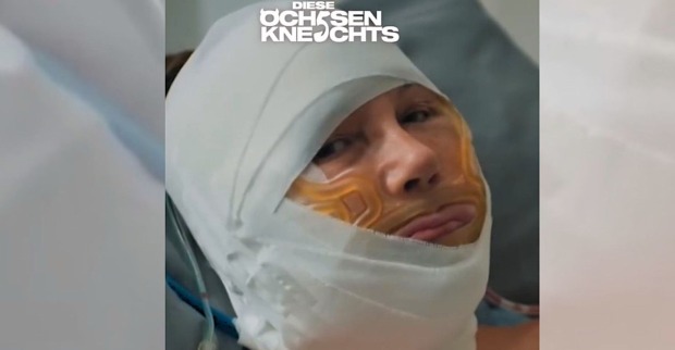 Natascha Ochsenknecht nach ihrer Halsstraffung in der Reality-Serie „Diese Ochsenknechts“ mit bandagiertem Kopf und geschwollenem Gesicht kurz nach der Beauty-OP.