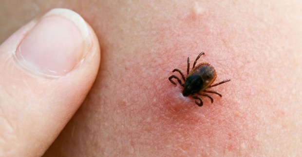 Zeckenbiss auf der Haut, die Tiere übertragen bereits seit 20 Jahren ALSV